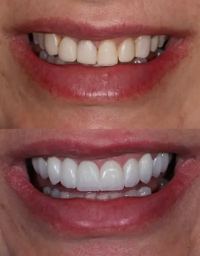 Arcada superior uniformizada com lentes, antes e depois do tratamento
