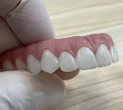 Prótese fixa sobre implantes pronta, antes da instalação