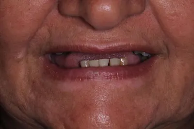 Reabilitação da arcada superior sobre implantes, antes do tratamento