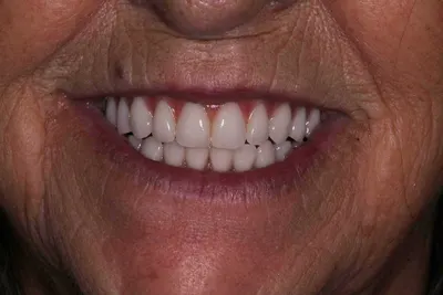 Reabilitação da arcada superior, depois do tratamento